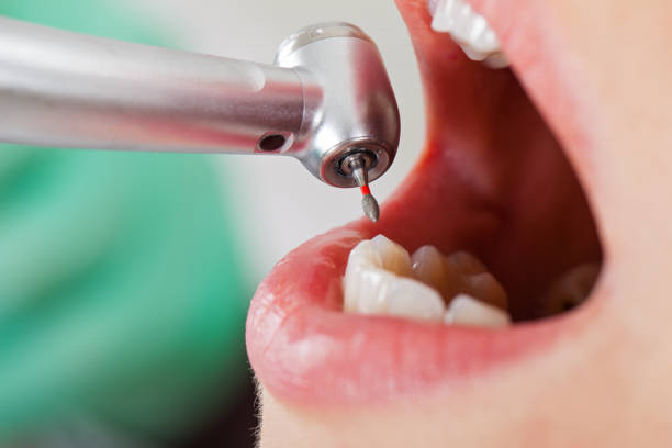 Best Emergency Dentist for Lost Fillings or Crowns in Oxford, NC